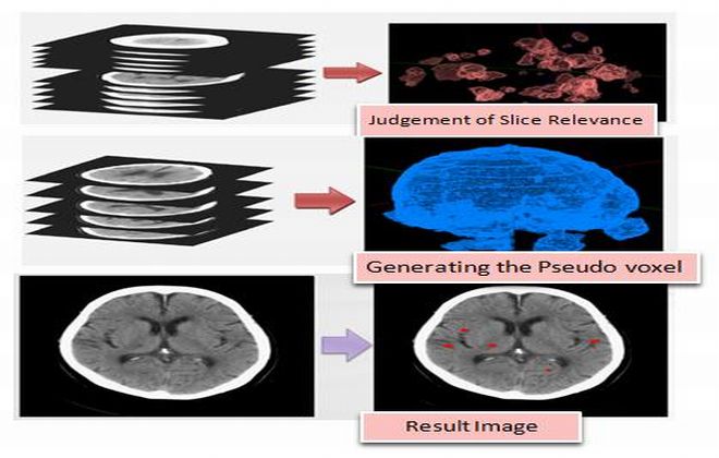 Research on Overdetected Region Restriction by Combining SVM and CT Slice Relevance for Automatic Lacunar Infraction Detection