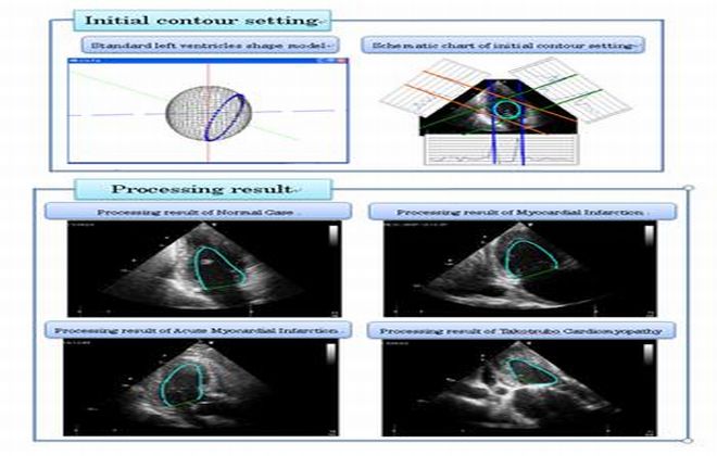 Automatic Endocardium Contour Tracing Method Using Standard Left Ventricles Shape Model